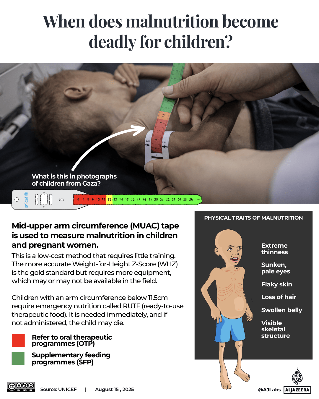 INTERACTIVE - Gaza malnutrition in children