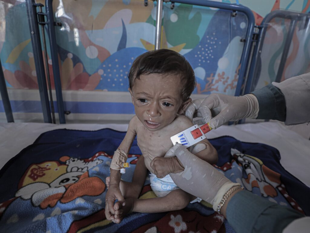Israel starving Gaza: 263 dead from starvation, including 112 children Israel starving Gaza: 263 dead from starvation, including 112 children