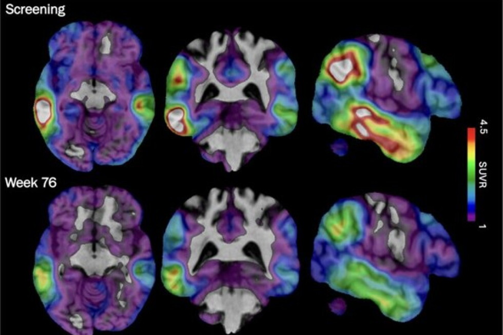 An experimental Alzheimer’s drug shows promise targeting a different brain protein, new study shows An experimental Alzheimer's drug shows promise targeting a different brain protein, new study shows
