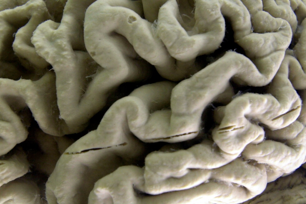 Study shows a blood test can help identify healthy people at high risk for Alzheimer’s disease Study shows a blood test can help identify healthy people at high risk for Alzheimer's disease