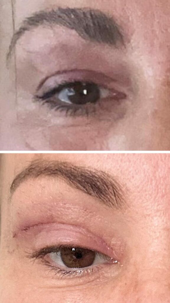 'My eyelids became infected – I was scared to sleep'Three women describe what happened when they travelled abroad for cheap "bleph" eyelid surgery.14 mins ago 'My eyelids became infected - I was scared to sleep'Three women describe what happened when they travelled abroad for cheap "bleph" eyelid surgery.14 mins ago